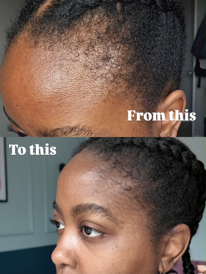 Kit repousse de cheveux 3